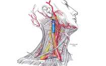 Полная задняя трифуркация правой внутренней сонной артерии