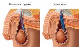 Расширение вен наружных половых органов у мужчин