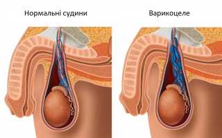 Расширение вен наружных половых органов у мужчин