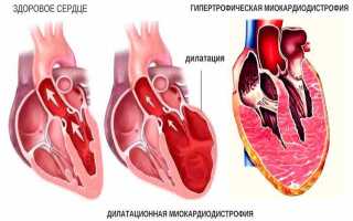 Алкогольная миокардиодистрофия