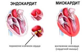 Кальциноз митрального клапана