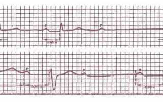 АВ блокада 2 степени