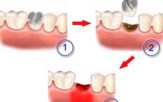 Осложнения после удаления зуба