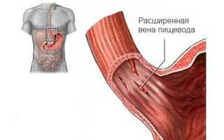 Варикозное расширение вен пищевода