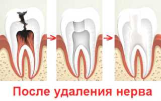 Боль в зубе при нажатии после удаления нерва