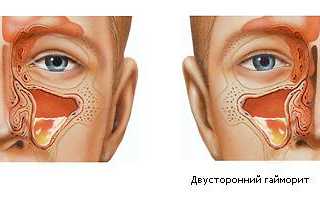 Причины боли в зубах при гайморите