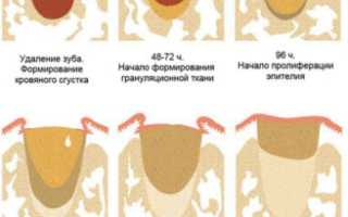 Эффективность Метрогил Дента после удаления зуба