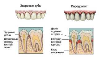 При каких патологиях зубов может болеть горло?