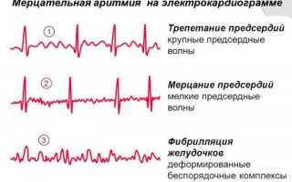 Правопредсердный ритм у детей