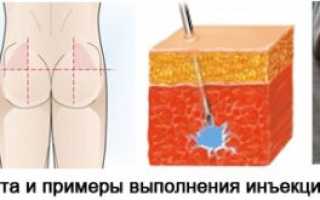 Противовоспалительные уколы препаратом Амелотекс: инструкция и схема лечения