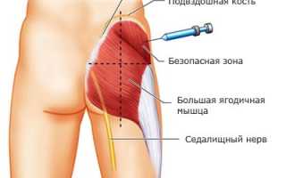 Алгоритм проведения внутримышечной инъекции