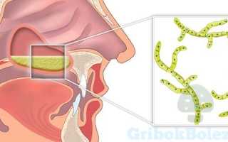 Образование грибкового гайморита в полости носа