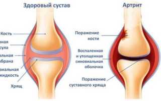 Уколы Дона: что излечивает препарат