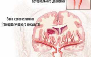 Геморрагический инсульт головного мозга